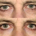 Blepharoplasty, A cosmetic surgery: A general understanding