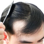 Hair Loss Treatment Mumbai, hair loss treatment for women, Best doctor for hair loss in Mumbai