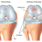 Rheumatoid Arthritis