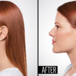 Double Chin Removal Vintage Houston TX