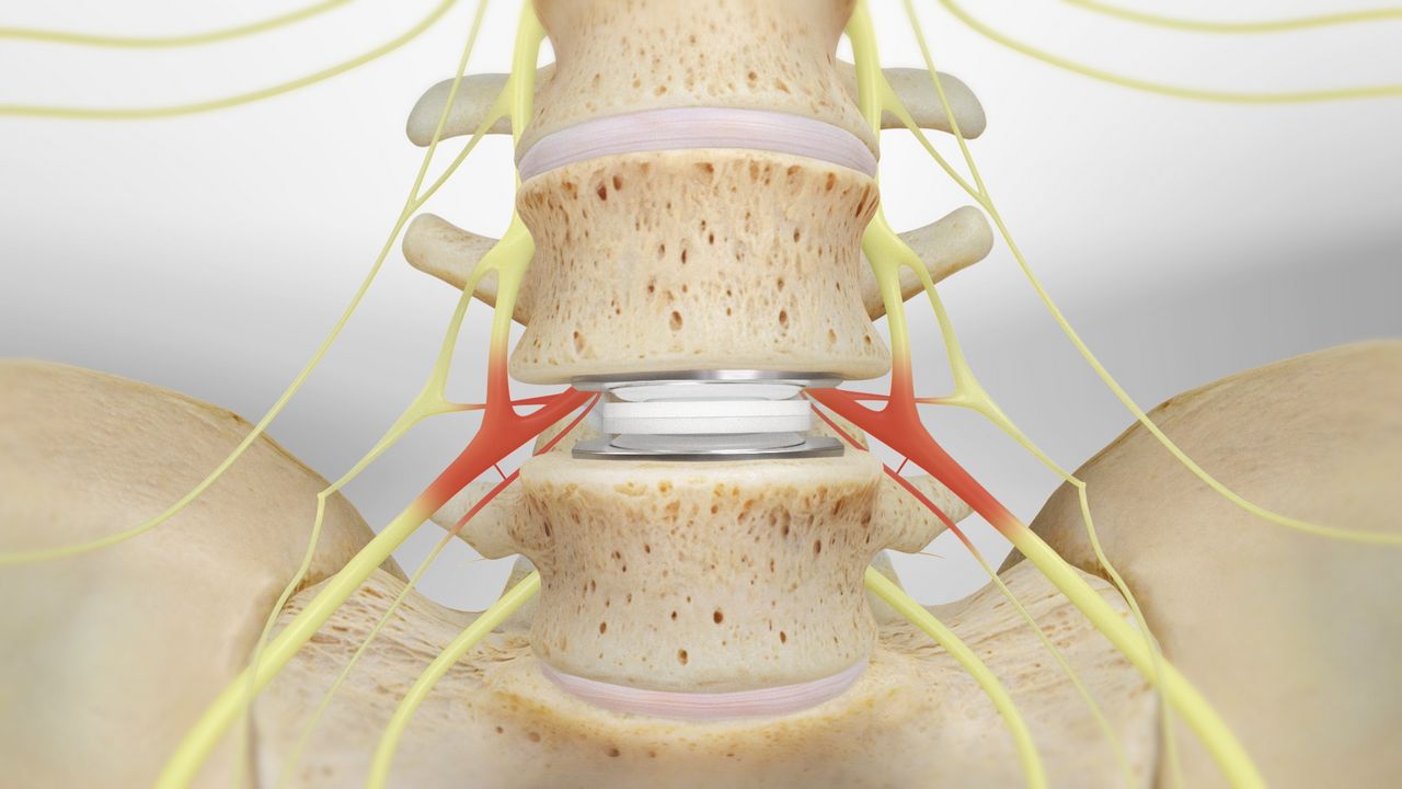 Spinal Disc Replacement